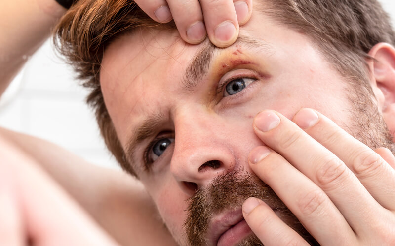 Man holding upper and lower eyelids open to examine a foreign object stuck in his eye