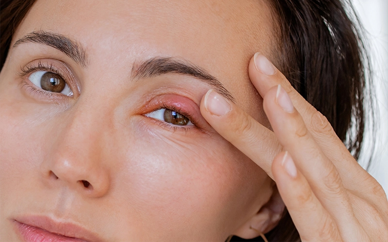 Red, swollen eyelid consistent with a stye (hordeolum) or chalazion