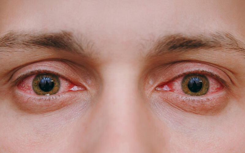A close-up of a red eye, a common sign of an eye infection like conjunctivitis.